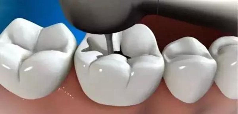隐形矫正：开启微笑的隐形门